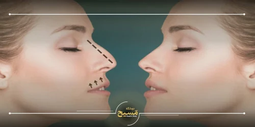 رینوپلاستی بینی استخوانی