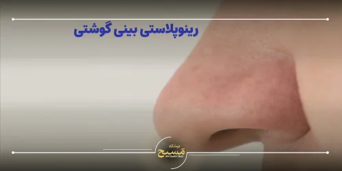 رینوپلاستی بینی گوشتی