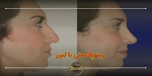 رینوپلاستی با لیزر