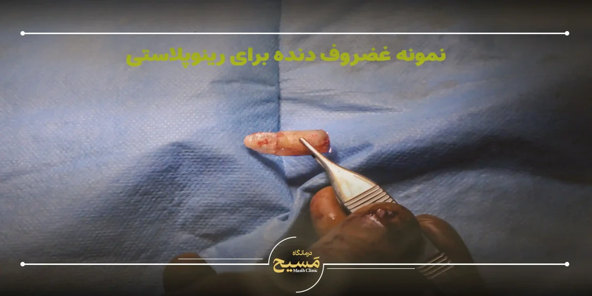 چه زمانی از غضروف دنده برای رینوپلاستی استفاده میشود؟ 1 مراحل استخراج و استفاده از غضروف دنده برای عمل بینی