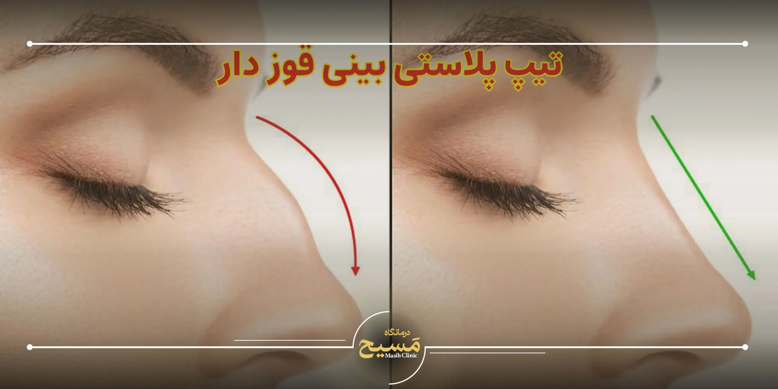 تیپ پلاستی بینی قوز دار