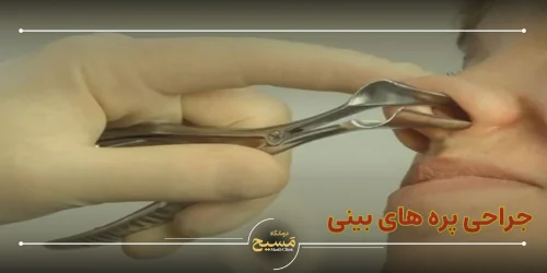 جراحی پره های بینی