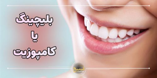 بلیچینگ بهتر است یا کامپوزیت؟