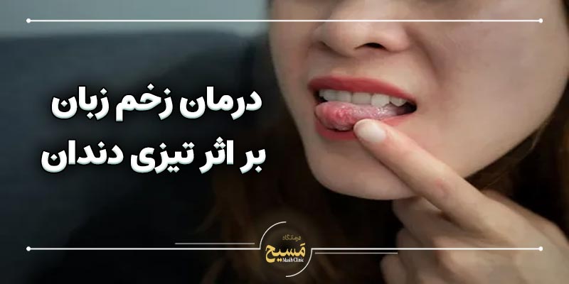 درمان خانگی تیزی دندان شکسته 1 درمان زخم زبان بر اثر تیزی دندان