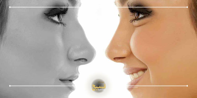 لیفت بینی با نخ 1 هزینه لیفت بینی با نخ 1403