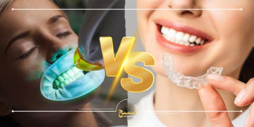 تفاوت بلیچینگ هوم و آفیس بلیچینگ