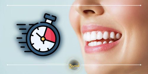 طول عمر لمینت دندان چقدر است؟