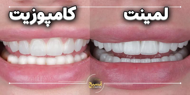 فرق لمینت و کامپوزیت