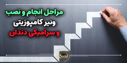 مراحل انجام و نصب ونیر کامپوزیتی و سرامیکی دندان