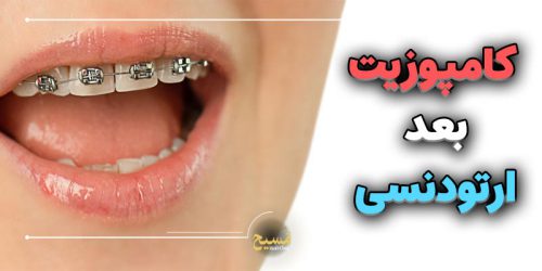 کامپوزیت بعد ارتودنسی