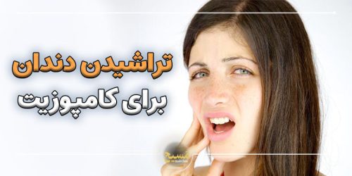 آیا برای کامپوزیت دندان را میتراشند