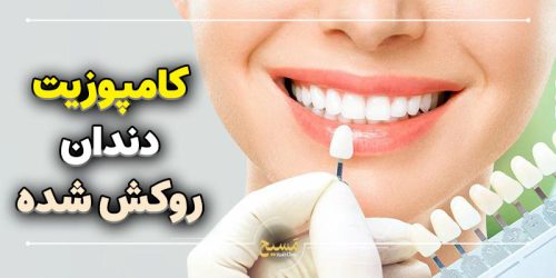 ایا دندان روکش شده را میتوان کامپوزیت کرد