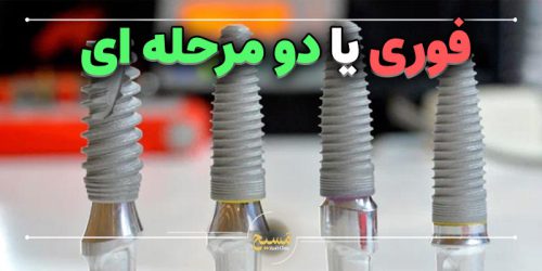 ایمپلنت فوری یا دو مرحله ای