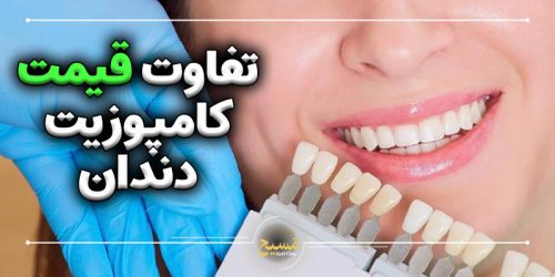 تفاوت قیمت کامپوزیت دندان