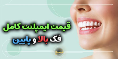 قیمت ایمپلنت کامل فک بالا و پایین