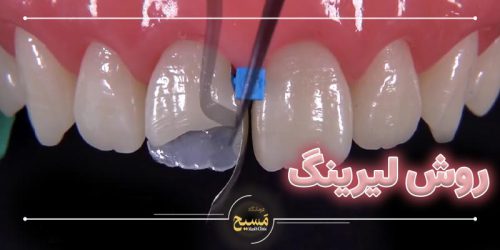 کامپوزیت دندان به روش لیرینگ