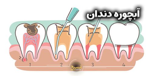 آبچوره دندان