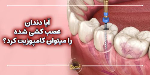 آیا دندان عصب کشی شده را میتوان کامپوزیت کرد؟