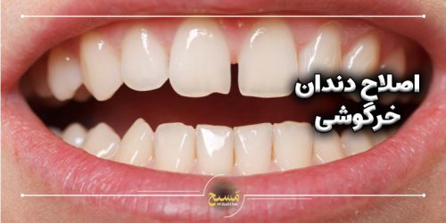 اصلاح دندان خرگوشی