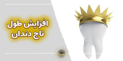 افزایش طول تاج دندان