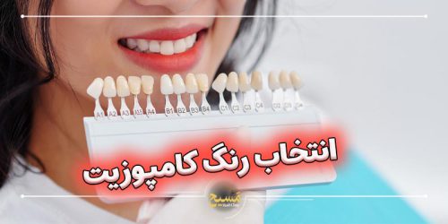 انتخاب رنگ کامپوزیت دندان