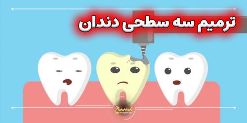 ترمیم سه سطحی دندان