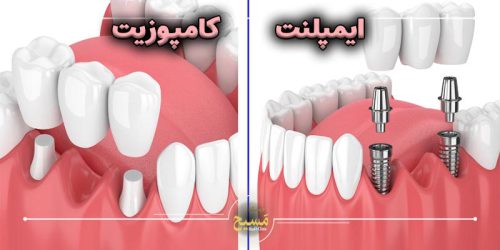 تفاوت ایمپلنت با کامپوزیت دندان