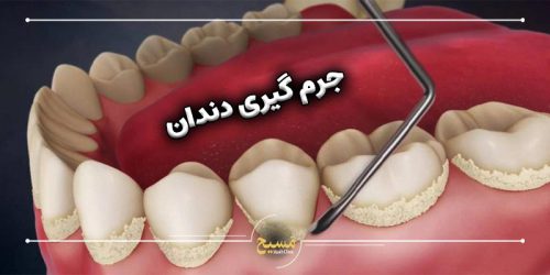 جرم گیری دندان