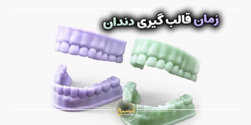 زمان قالب گیری دندان