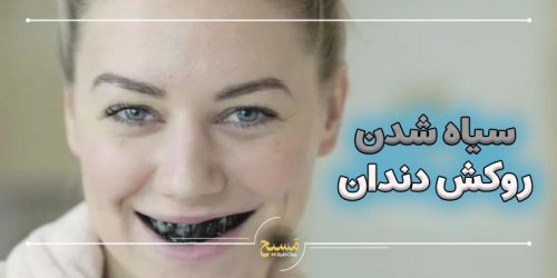 علت سیاه شدن روکش دندان
