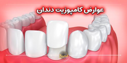 عوارض کامپوزیت دندان