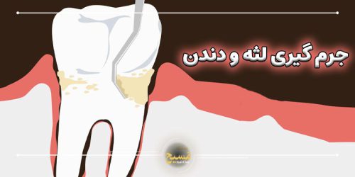 فرق جرم گیری لثه با جرم گیری دندان
