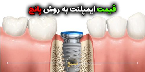 قیمت ایمپلنت به روش پانچ