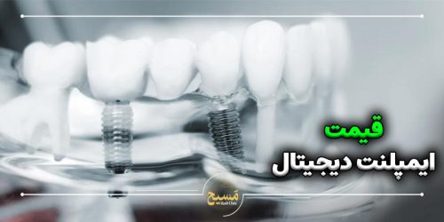 قیمت ایمپلنت دیجیتال در مرکز تهران