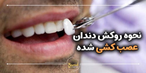 نحوه روکش دندان عصب کشی شده