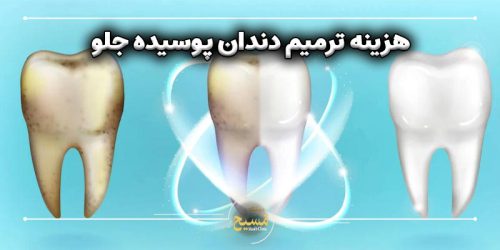 هزینه ترمیم دندان پوسیده جلو