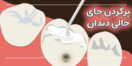 پرکردن جای خالی دندان