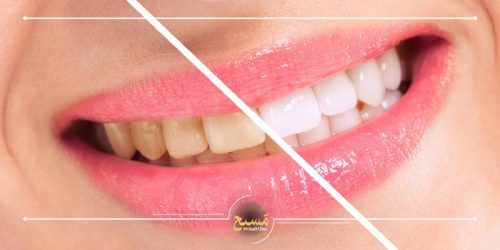 چگونه دندان کامپوزیت شده را سفید کنیم