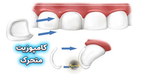 کامپوزیت متحرک دندان