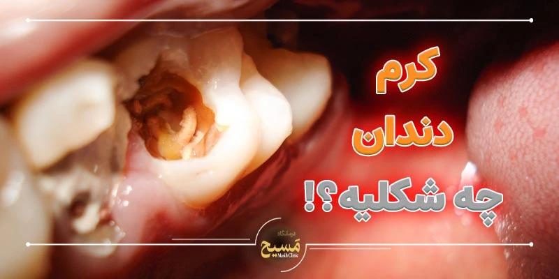 کرم دندان چه شکلی است