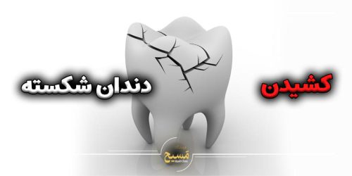 کشیدن دندان شکسته