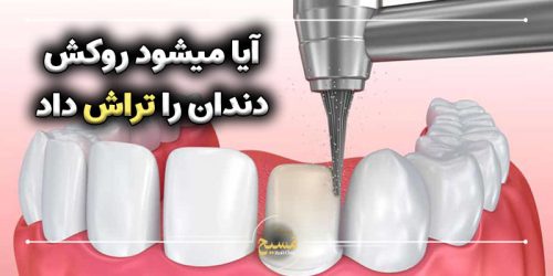 آیا میشود روکش دندان را تراش داد
