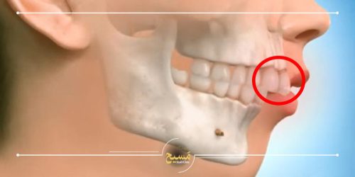 آیا کامپوزیت باعث جلو آمدن دندان میشود