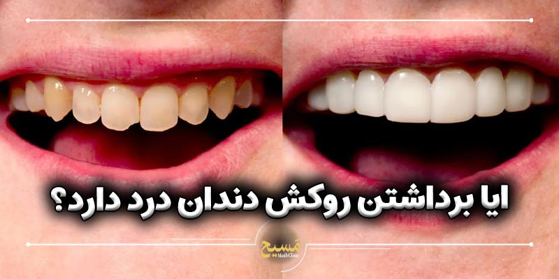 ایا برداشتن روکش دندان درد دارد