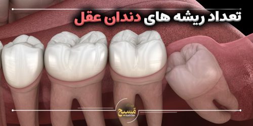 تعداد ریشه های دندان عقل