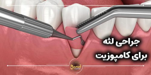 جراحی لثه برای کامپوزیت