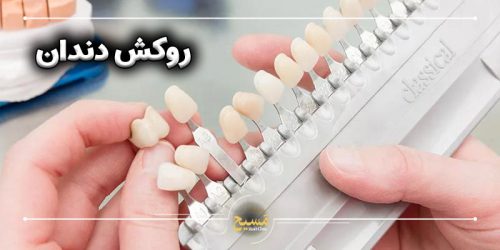 روکش دندان