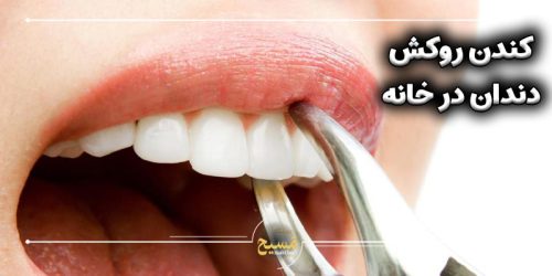 طریقه کندن روکش دندان در خانه