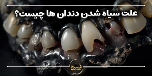 علت سیاه شدن دندان ها چیست؟