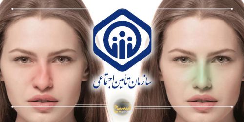 هزینه عمل انحراف بینی با بیمه تامین اجتماعی